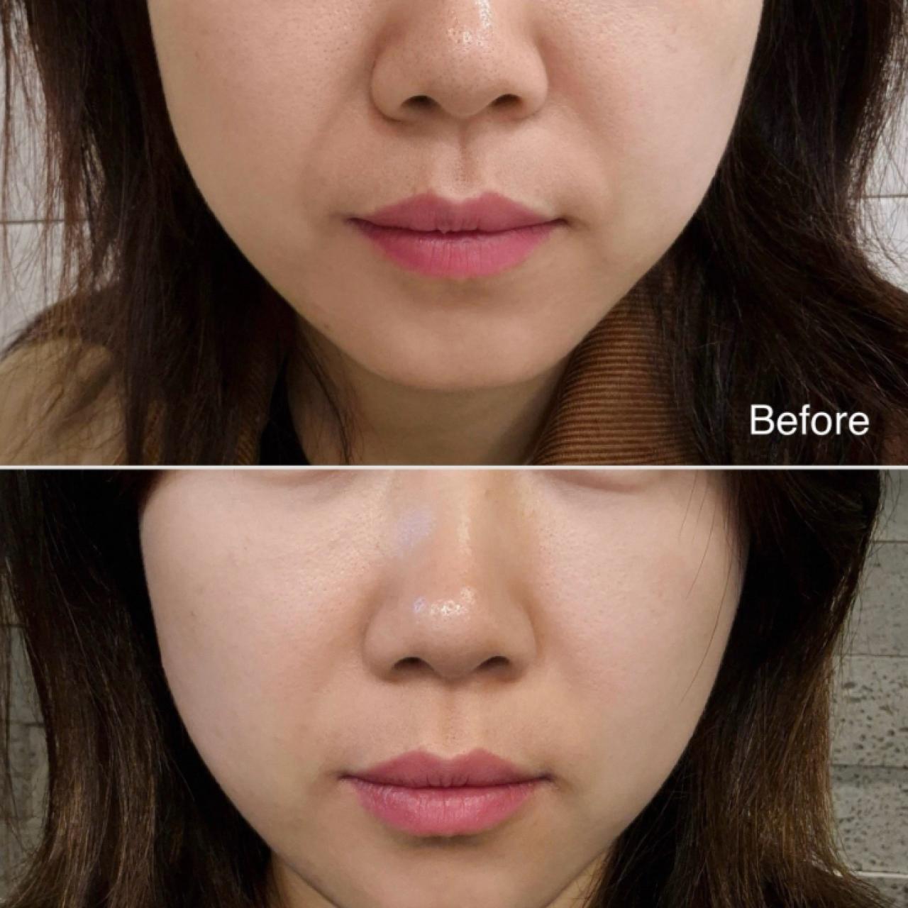 슈링크 300샷 팔자