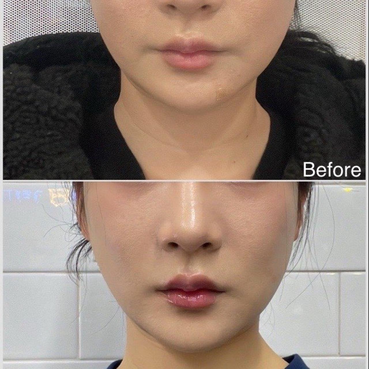 피팅레이저/티타늄리프팅레이저