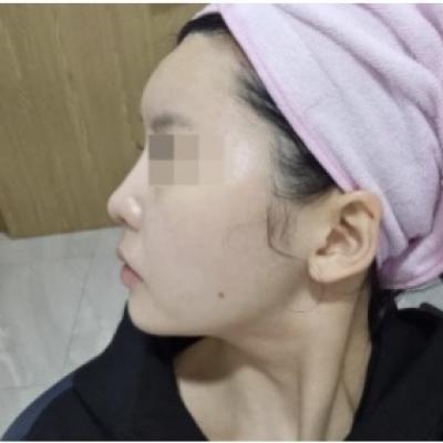 울쎄라+써마지 잘하는 곳 울쎄라 이벤트