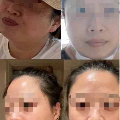 아이필유 클리닉만의 인모드 , 인모드 전후 사진