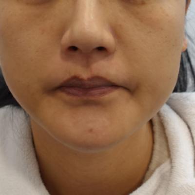 울쎄라 300샷 + 덴서티 300샷 효과, 주의 점