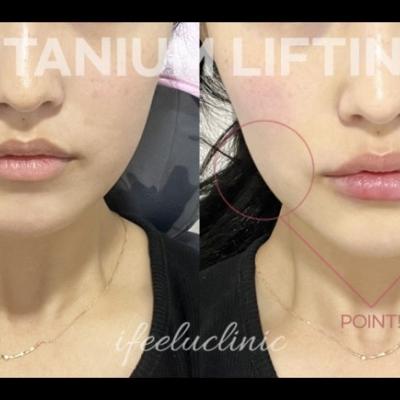 티타늄 리프팅 전 후 case 사진