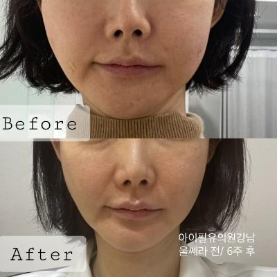 울쎄라 600샷 후기, 통증,   셀프시술 후기